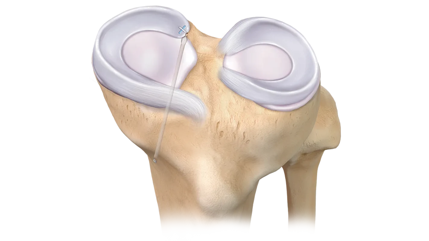 N_Meniscal_Root_Repair_nakn0f